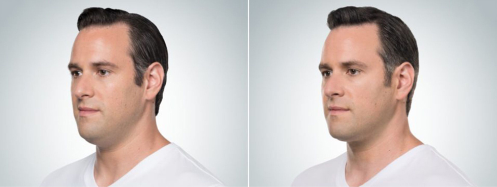 Lipolytic Peptide before-after_4